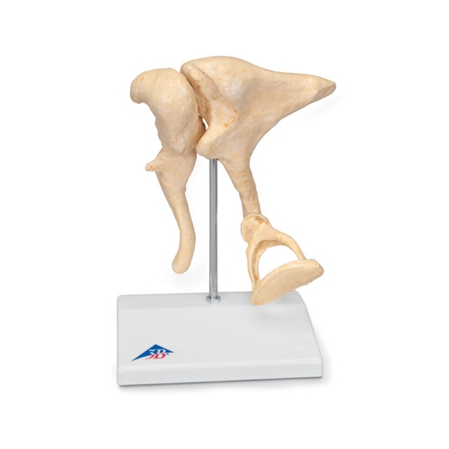 Otoskleroza Kosteczek Słuchowych