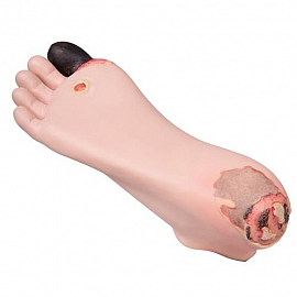 Model Stopy Cukrzycowej