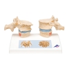 Model osteoporozy